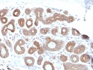 Immunohistochemical analysis of formalin-fixed, paraffin-embedded human breast carcinoma using Anti-Calpain 1 Antibody [CAPN1/1530]