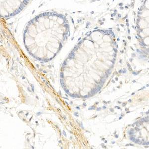 Immunohistochemistry analysis of paraffin-embedded human colon tissue using Anti-TAGLN/Transgelin Antibody (A9989) at a dilution of 1:20 (40X lens). Perform high pressure antigen retrieval with 10 mM citrate buffer pH 6.0 before commencing with IHC staining protocol