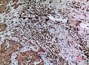 Immunohistochemical analysis of paraffin-embedded human mammary cancer using Anti-CACYBP Antibody