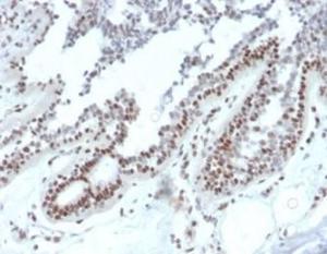 Immunohistochemical analysis of formalin-fixed, paraffin-embedded human breast carcinoma tissue using Anti-NME1 Antibody [NME1/2738]