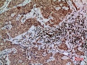 Immunohistochemical analysis of paraffin-embedded human mammary cancer using Anti-CACYBP Antibody