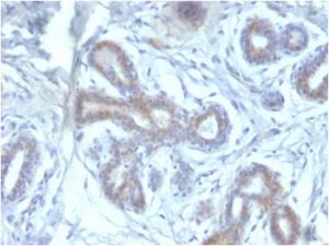 Immunohistochemical analysis of formalin-fixed, paraffin-embedded human breast carcinoma using Anti-BAP1 Antibody [BAP1/2433]