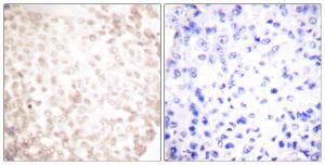 Immunohistochemical analysis of paraffin-embedded human lung carcinoma tissue using Anti-XRCC1 Antibody. The right hand panel represents a negative control, where the antibody was pre-incubated with the immunising peptide.