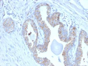 Immunohistochemical analysis of formalin-fixed, paraffin-embedded human prostate carcinoma using Anti-PMEPA1 Antibody [PMEPA1/2697]