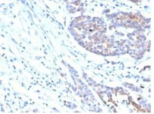 Immunohistochemical analysis of formalin-fixed, paraffin-embedded human colon carcinoma tissue using Anti-IGF1 Receptor Antibody [IGF1R/4667]