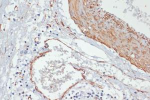 Immunohistochemistry analysis of paraffin-embedded human gastric cancer using Anti-MYL9 (phospho Thr18 + Ser19) Antibody (A305466) at a dilution of 1:100 (40X lens). Perform microwave antigen retrieval with 10 mM Tris/EDTA buffer pH 9.0 before commencing with IHC staining protocol