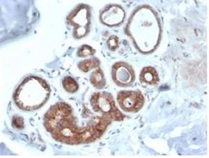 Immunohistochemical analysis of formalin-fixed, paraffin-embedded human breast carcinoma tissue using Anti-IGF1 Receptor Antibody [IGF1R/4667]