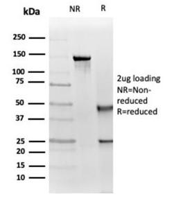 Immunohistochemical analysis of formalin-fixed, paraffin-embedded human prostate carcinoma tissue using Anti-IGF1 Receptor Antibody [IGF1R/4667]