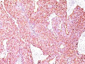 Immunohistochemical analysis of formalin-fixed, paraffin-embedded human small cell lung carcinoma using Anti-Chromogranin A Antibody [CGA/414]