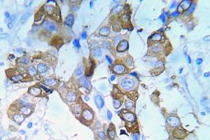 Immunohistochemical analysis of paraffin-embedded human lung adenocarcinoma tissue using Anti-IGF-IR (phospho Tyr980) Antibody