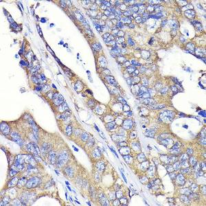 Immunohistochemistry analysis of paraffin-embedded human colon carcinoma tissue using Anti-Fatty Acid Synthase Antibody [ARC0377] (A305468) at a dilution of 1:100 (40X lens). Perform microwave antigen retrieval with 10 mM PBS buffer pH 7.2 before commencing with IHC staining protocol