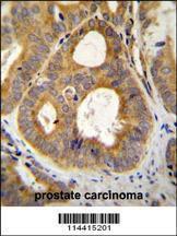 TRPM8 Antibody immunohistochemistry analysis in formalin fixed and paraffin embedded human prostate carcinoma followed by peroxidase conjugation of the secondary antibody and DAB staining