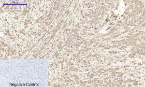 Immunohistochemical analysis of paraffin-embedded human breast cancer tissue using Anti-ITGB3 Antibody at 1:200 (4°C overnight). Negative control was secondary antibody only