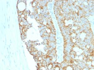 Immunohistochemical analysis of formalin-fixed, paraffin-embedded human colon carcinoma using Anti-MAML2 Antibody [MAML2/1302]