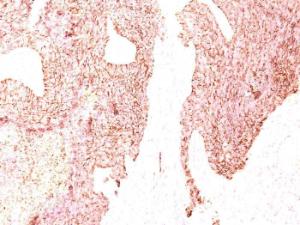 Immunohistochemical analysis of formalin-fixed, paraffin-embedded human small cell lung carcinoma using Anti-Chromogranin A Antibody [LK2H10]