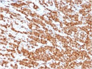 Immunohistochemical analysis of formalin-fixed, paraffin-embedded human colon carcinoma tissue using Anti-IL-2 Antibody [IL2/3949]