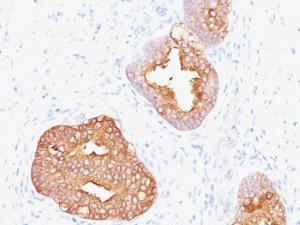 Immunohistochemical analysis of formalin-fixed, paraffin-embedded human prostate carcinoma using Anti-Prostate Specific Antigen Antibody [1A7]