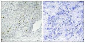 Immunohistochemical analysis of paraffin-embedded human breast cancer using Anti-MEKKK 1 Antibody 1:100 (4°C overnight). The right hand panel represents a negative control, where the antibody was pre-incubated with the immunising peptide