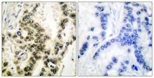 Immunohistochemical analysis of paraffin-embedded human lung carcinoma using Anti-SRF (phospho Ser99) Antibody. The right hand panel represents a negative control, where the antibody was pre-incubated with the immunising peptide