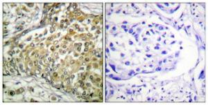 Immunohistochemical analysis of paraffin-embedded human lung carcinoma tissue using Anti-p53 (acetyl Lys379) Antibody. The right hand panel represents a negative control, where the antibody was pre-incubated with the immunising peptide.