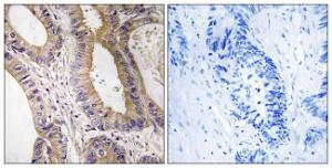 Immunohistochemical analysis of paraffin-embedded human colon carcinoma tissue using Anti-STK24 Antibody. The right hand panel represents a negative control, where the Antibody was pre-incubated with the immunising peptide