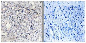 Immunohistochemical analysis of paraffin-embedded human liver carcinoma tissue using Anti-Heparin Cofactor II Antibody. The right hand panel represents a negative control, where the antibody was pre-incubated with the immunising peptide