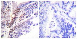 Immunohistochemical analysis of paraffin-embedded human lung carcinoma using Anti-GR (phospho Ser226) Antibody. The right hand panel represents a negative control, where the Antibody was pre-incubated with the immunising peptide