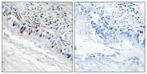 Immunohistochemical analysis of paraffin-embedded human lung cancer using Anti-IP3KC Antibody 1:100 (4°C overnight). The right hand panel represents a negative control, where the antibody was pre-incubated with the immunising peptide.