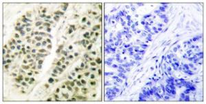 Immunohistochemical analysis of paraffin-embedded human breast carcinoma tissue using Anti-DNA Polymerase beta Antibody. The right hand panel represents a negative control, where the Antibody was pre-incubated with the immunising peptide