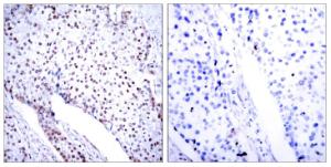 Immunohistochemical analysis of paraffin-embedded human breast carcinoma tissue using Anti-STAT3 Antibody. The right hand panel represents a negative control, where the antibody was pre-incubated with the immunising peptide