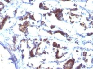 Immunohistochemical analysis of formalin-fixed, paraffin-embedded human gastric carcinoma using Anti-ZFYVE28 Antibody [LST2/2426]