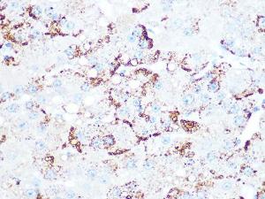 Immunohistochemistry analysis of paraffin-embedded human liver cancer using Anti-Cathepsin L/V/K/H Antibody [ARC1276] (A305481) at a dilution of 1:100 (40x lens) Perform microwave antigen retrieval with 10 mM PBS buffer pH 72 before commencing with IHC staining protocol