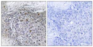 Immunohistochemical analysis of paraffin-embedded human breast carcinoma tissue using Anti-ZMY11 Antibody. The right hand panel represents a negative control, where the antibody was pre-incubated with the immunising peptide.