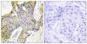 Immunohistochemical analysis of paraffin-embedded human breast carcinoma tissue using Anti-IARS2 Antibody. The right hand panel represents a negative control, where the Antibody was pre-incubated with the immunising peptide