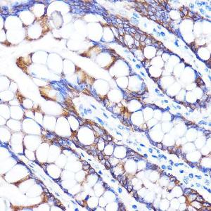 Immunohistochemistry analysis of paraffin-embedded human colon tissue using Anti-ZMPSTE24 Antibody (A305482) at a dilution of 1:100 (40x lens). Perform microwave antigen retrieval with 10 mM PBS buffer pH 7.2 before commencing with IHC staining protocol.