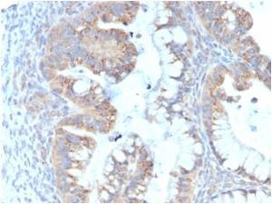 Immunohistochemical analysis of formalin-fixed, paraffin-embedded human colon carcinoma tissue using Anti-IL-7 Antibody [IL7/4013]