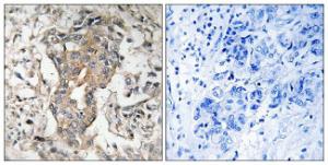 Immunohistochemical analysis of paraffin-embedded human breast carcinoma tissue using Anti-SPHK2 Antibody The right hand panel represents a negative control, where the antibody was pre-incubated with the immunising peptide