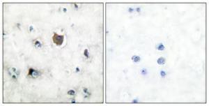 Immunohistochemical analysis of paraffin-embedded human breast cancer using Anti-Trk B Antibody 1:100 (4 °C overnight). The right hand panel represents a negative control, where the Antibody was pre-incubated with the immunising peptide