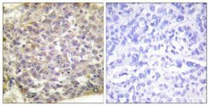 Immunohistochemical analysis of paraffin-embedded human breast carcinoma tissue using Anti-14-3-3 zeta Antibody. The right hand panel represents a negative control, where the antibody was pre-incubated with the immunising peptide.