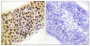 Immunohistochemical analysis of paraffin-embedded human liver carcinoma tissue using Anti-TIP60 Antibody The right hand panel represents a negative control, where the antibody was pre-incubated with the immunising peptide