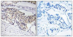 Immunohistochemical analysis of paraffin-embedded human breast carcinoma tissue using Anti-NDUFA3 Antibody. The right hand panel represents a negative control, where the antibody was pre-incubated with the immunising peptide.