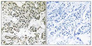 Immunohistochemical analysis of paraffin-embedded human breast carcinoma tissue using Anti-THOC5 Antibody The right hand panel represents a negative control, where the antibody was pre-incubated with the immunising peptide