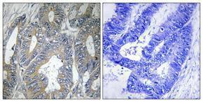 Immunohistochemical analysis of paraffin-embedded human colon cancer using Anti-HSPB2 Antibody 1:100 (4°C overnight). The right hand panel represents a negative control, where the antibody was pre-incubated with the immunising peptide