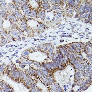 Immunohistochemistry analysis of paraffin-embedded human colon carcinoma tissue using Anti-Thrombospondin 1 Antibody (A11512) at a dilution of 1:50 (40x lens). Perform high pressure antigen retrieval with 10 mM citrate buffer pH 6.0 before commencing with IHC staining protocol.