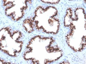 Immunohistochemical analysis of formalin-fixed, paraffin-embedded human prostate carcinoma using Anti-Prostein Antibody [ZR9]