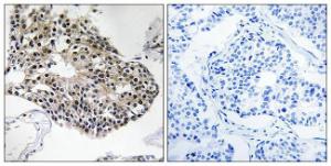 Immunohistochemical analysis of paraffin-embedded human breast carcinoma tissue using Anti-RPS25 Antibody. The right hand panel represents a negative control, where the antibody was pre-incubated with the immunising peptide