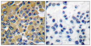 Immunohistochemical analysis of paraffin-embedded human breast carcinoma tissue using Anti-SHP-2 Antibody. The right hand panel represents a negative control, where the antibody was pre-incubated with the immunising peptide