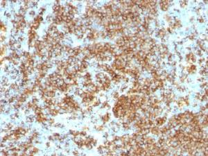 Immunohistochemical analysis of formalin-fixed, paraffin-embedded human lymphoma using Anti-CD45RB Antibody [PTPRC/1132]