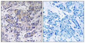 Immunohistochemical analysis of paraffin-embedded human breast carcinoma tissue using Anti-RPS21 Antibody. The right hand panel represents a negative control, where the antibody was pre-incubated with the immunising peptide