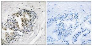 Immunohistochemical analysis of paraffin-embedded human prostate carcinoma tissue using Anti-RPLP2 Antibody. The right hand panel represents a negative control, where the antibody was pre-incubated with the immunising peptide.